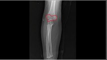 Broken Elbow in Children - Supracondylar Humerus Fracture Treatment