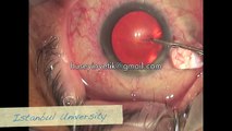 Cataract Phacoemulsification Surgery in TURKEY Dr. Huseyin Yetik