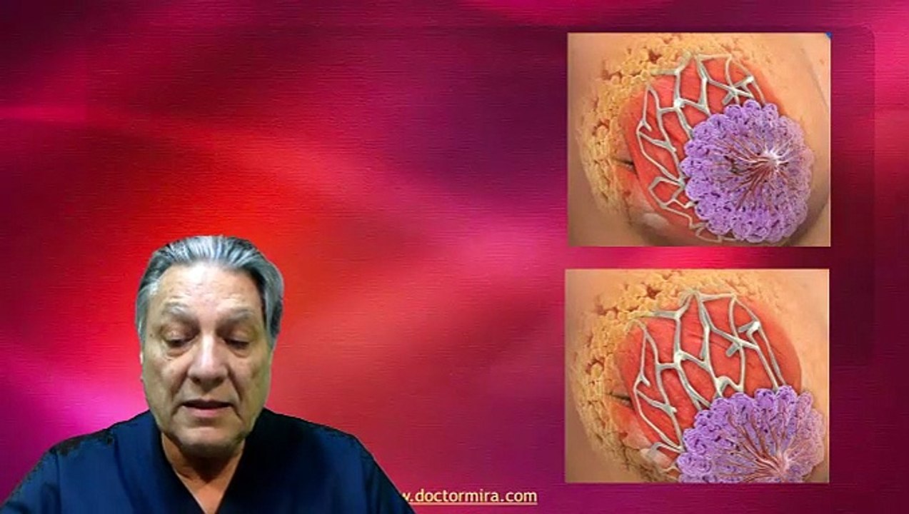 Mastopexia aumentativa