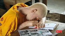 Under The Same Sun: African Albinos become prey