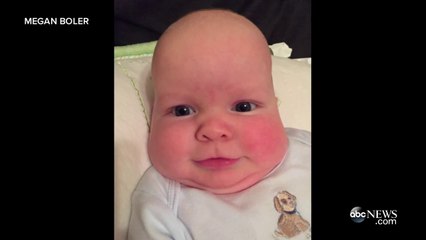 Un enfant nait avec la tête déformée doit porter un casque pour retrouver une forme normale