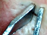 Popping a Blackhead in Ear with Needle and Tweezers