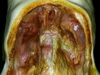 02 Cavidad Abdominal y Peritoneo