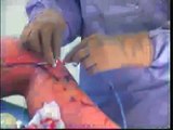 Laserchirurgie varices spataders