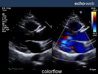 The EchoWeb - Bicuspid Aortic Valve