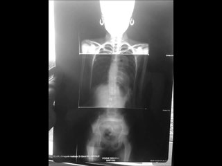 Opération Scoliose, Scoliosis Surgery