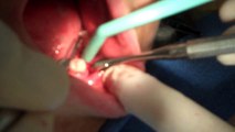 Implant placement for a failed root canal tooth Robert Antolak TheGentleDentist com