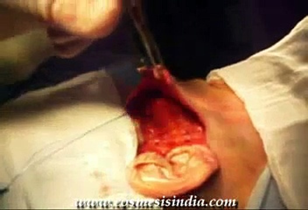 Cosmetic Surgery in  India - Dr.Surindher - Face lift ( MACS lift)