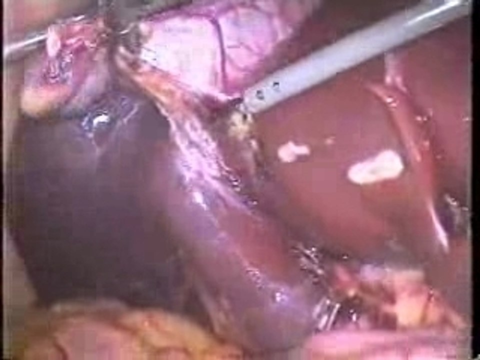 Laparoscopic Gall Bladder Removal