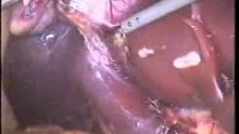Laparoscopic Gall Bladder Removal