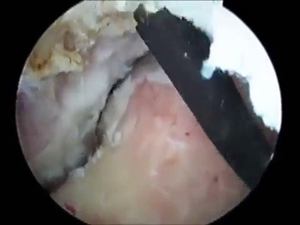 HIP ARTHROSCOPY EXCISION OF HETEROTOPIC OSSIFICATION, DR ROBERT RUPP