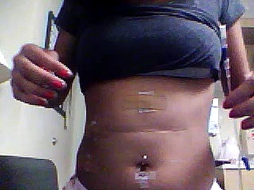 gallbladder removal  - Laparoscopic Cholecystectomy, gallstones