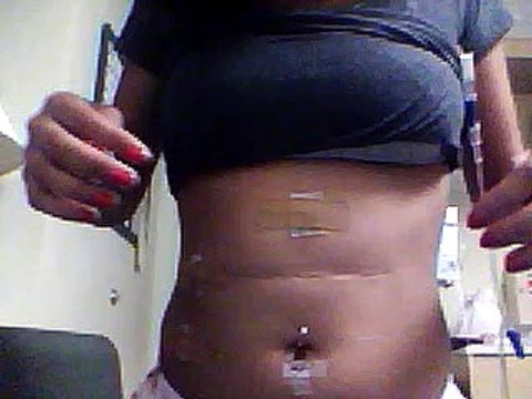 gallbladder removal - Laparoscopic Cholecystectomy, gallstones