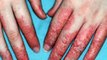 Eczema Treatment - The Benefits of Treating Eczema with Home Remedies