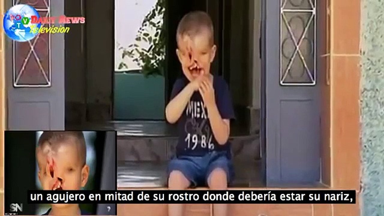 Conoce la historia del niño que nació sin ojos, sin mandibula y sin nariz Vídeo Dailymotion