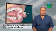 د.حسام عاشور - تركيبات الاسنان المتحركه