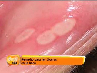 Remedios para las úlceras en su boca