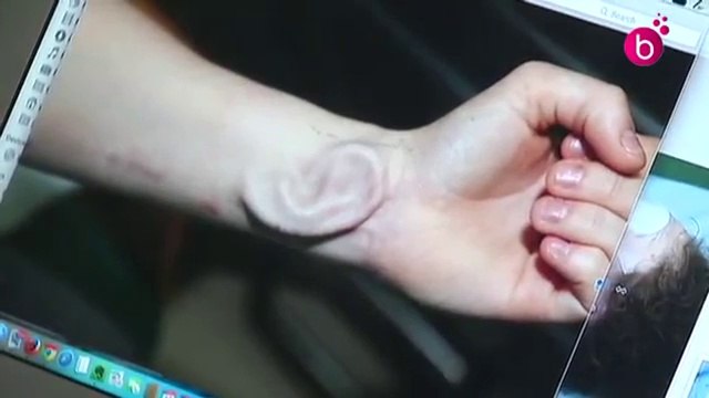 Medecine : Greffe d'une oreille sur un avant-bras