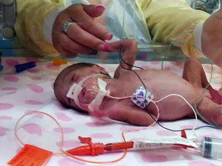 Emma preemie baby born at 24 weeks and 4 days