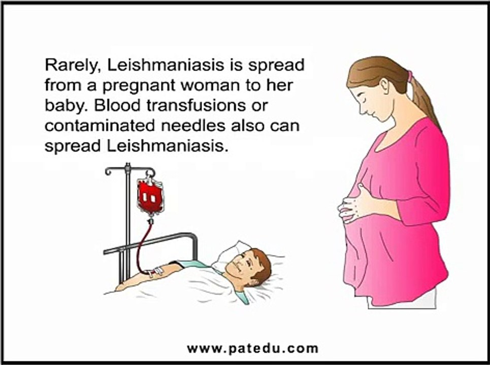 Leishmaniasis -- Causes, Symptoms, Diagnosis and Treatment