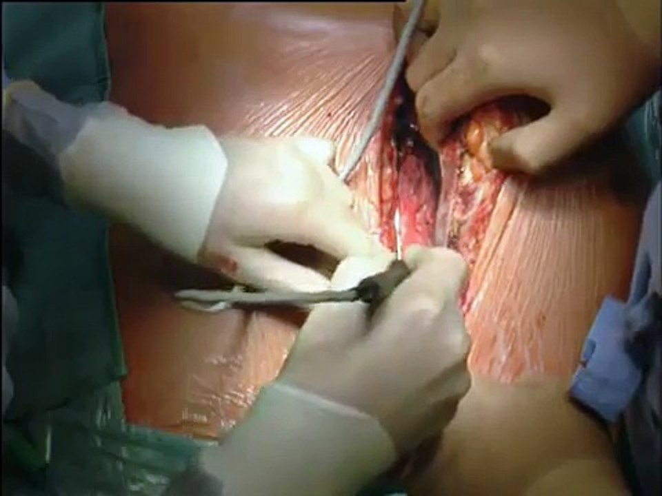 01 Mediane Sternotomie