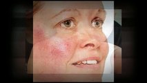 Skin Diseases - Types and Causes