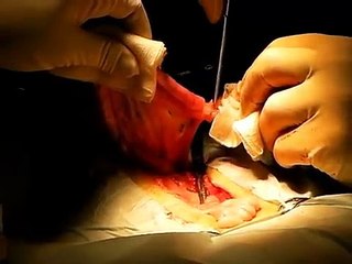 Ovario chienne : Technique colliers de serrage.wmv