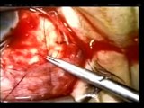 Spontaneous Posterior Capsule Rupture in Cataract Surgery - Dr. Mauricio Turati Acosta