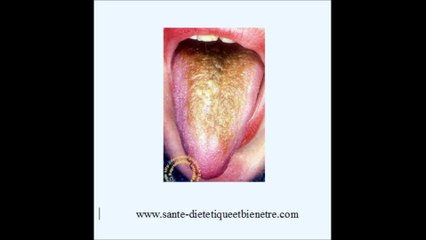 Candidoses ou mycoses buccales