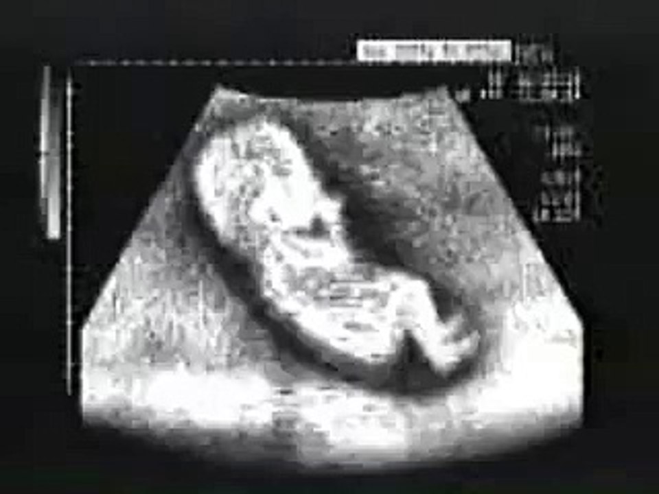 Ultrasound driving
