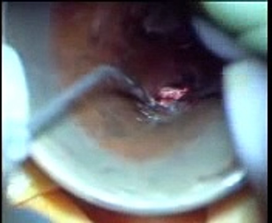 otosclerosis