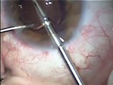how to explant an IOL after prior cataract surgery with complications