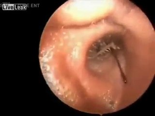 IL A SENTI UNE DOULEUR À L’OREILLE.. MAIS CE QUE LE DOCTEUR LUI A ENLÈVÉ EST VRAIMENT HALLUCINANT