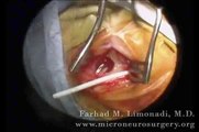 Minimally invasive brain surgery (third ventriculostomy) through a keyhole approach.