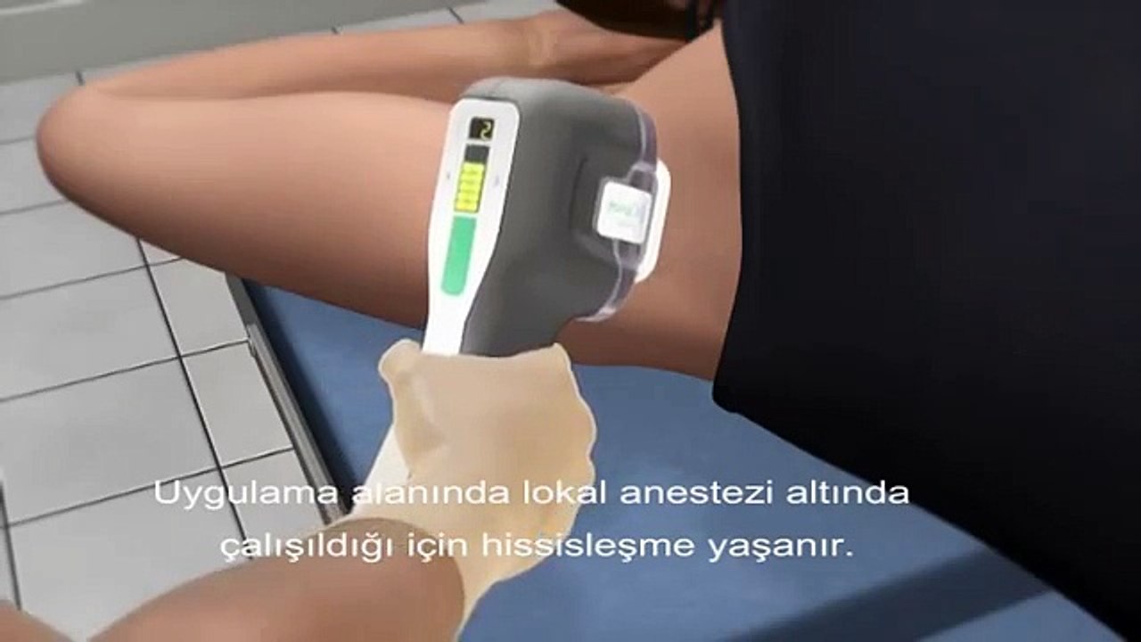 miradry terleme tedavisi