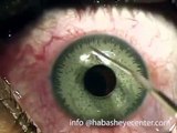 Refractive surgery ( PRK ) after brightocular artificial iris implantation