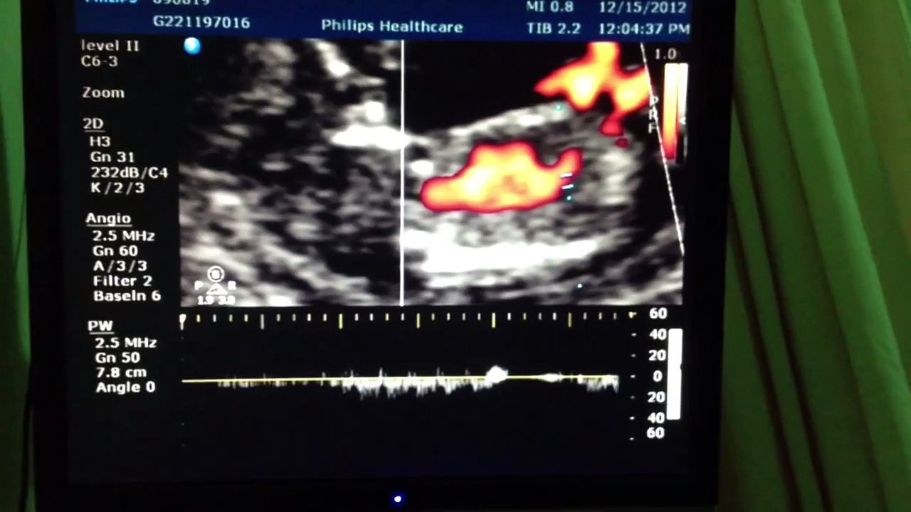 101.12.15 baby11周做頸部透明帶 高層次超音波