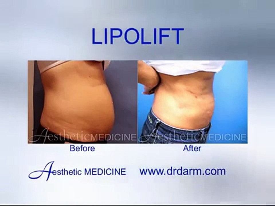 Dr. Darm LipoLift Before and After - Abdomen, flanks, and bra bulge
