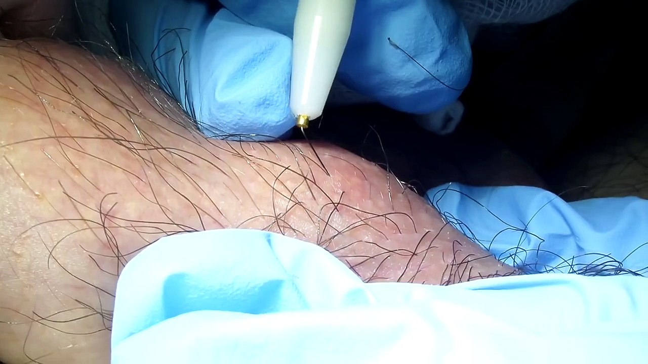 Depilación Eléctrica en región púbica masculina