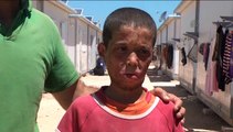 Syrian child refugee Ahmet Kedru burnt in tent fire needs face transplant