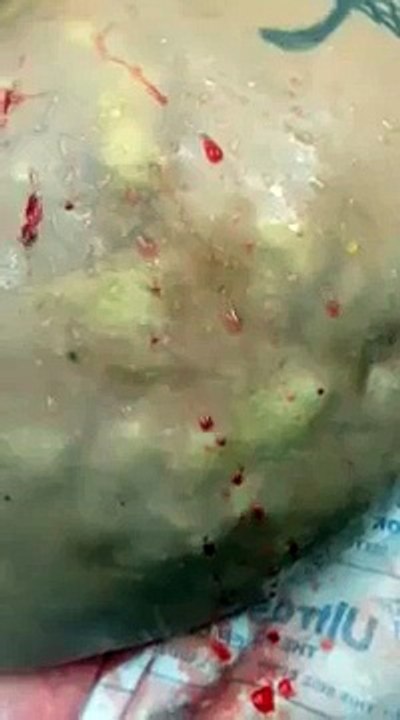 Remove silicone shots. Remove silicone butt injections,remove biogel shots,remove hydrojel shots