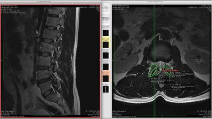 Resonancia Magnética de Canal Lumbar Estrecho L4-L5