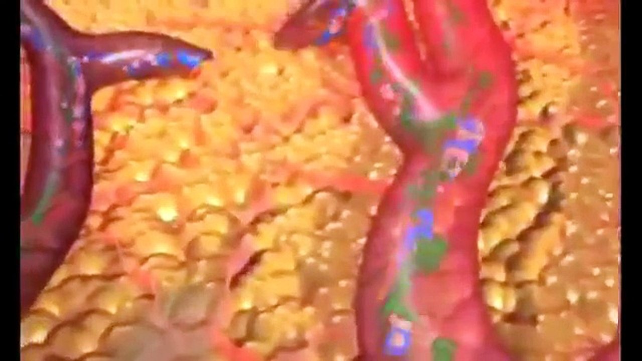 Ultrasound & Radio Frequency Fat Cavitation- How does it work