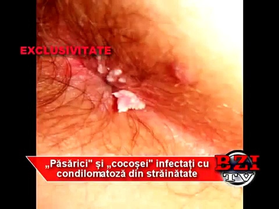Pasarici si cocosei infectati cu condilomatozA din strainatate