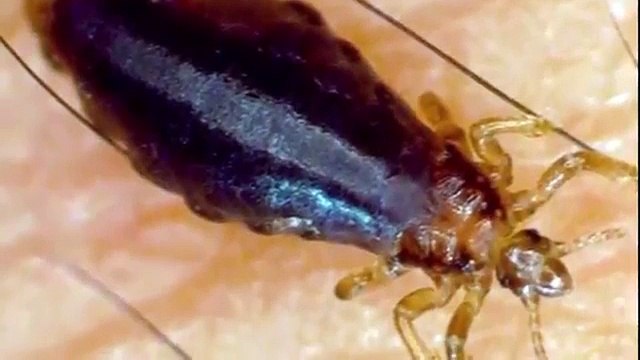 Como eliminar los piojos con alcohol remedios caseros para los piojos