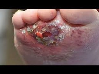 Top 5 Most Painful Insect Bites