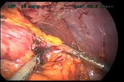 Failed Lap Band to Gastric Imbrication;  A New Concept in Bariatric Surgery
