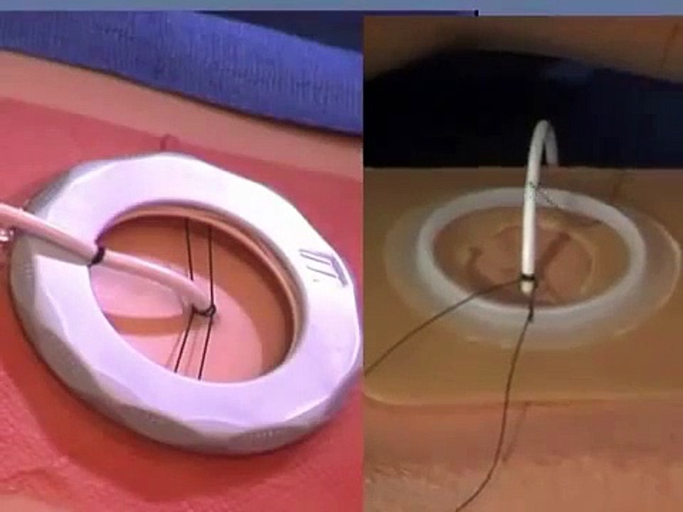 Revolution™ Catheter Securement Device Video