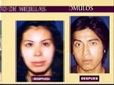 Rejuvenecimiento Facial Sin Cirugia - Botox, Rellenos Faciales, Acne, Manchas
