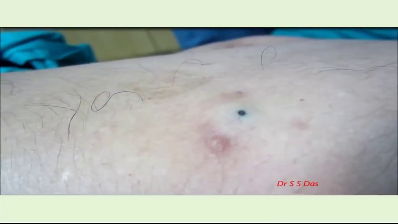 How to remove the sebaceous cyst in left arm 2015 HD I Cyst Removal Surgery